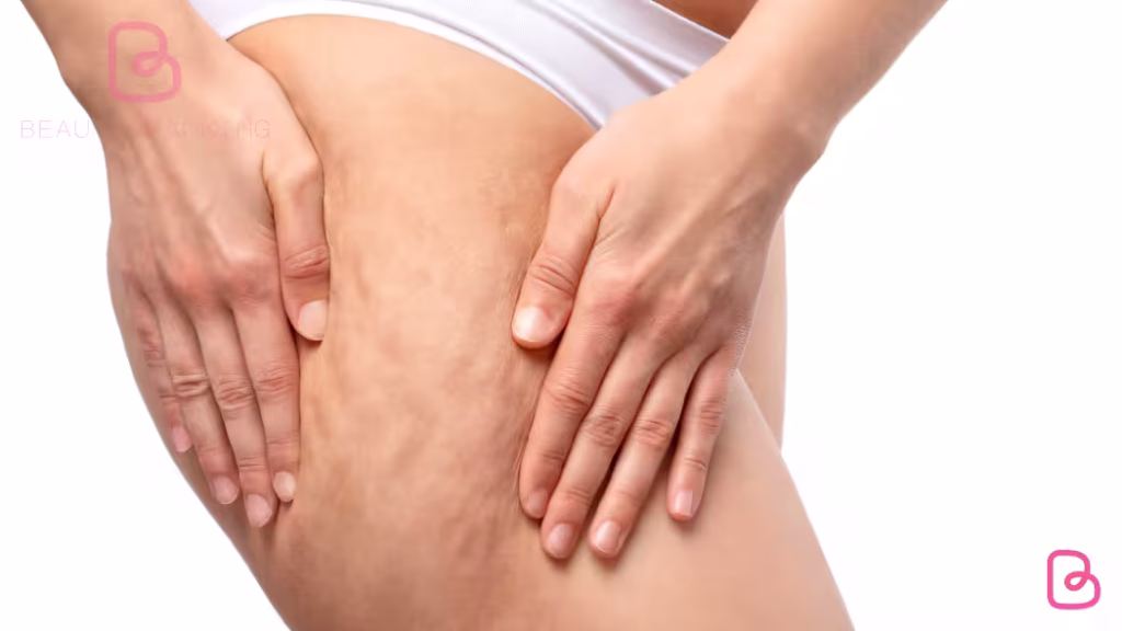 szczypniecie uda cellulit szczypniecie uda cellulit